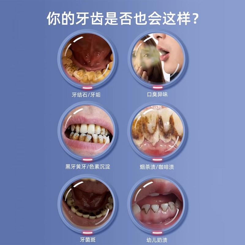 neward声波可视洗牙器洁牙仪冲牙结石去除神器牙齿清洁污垢除牙垢-图0