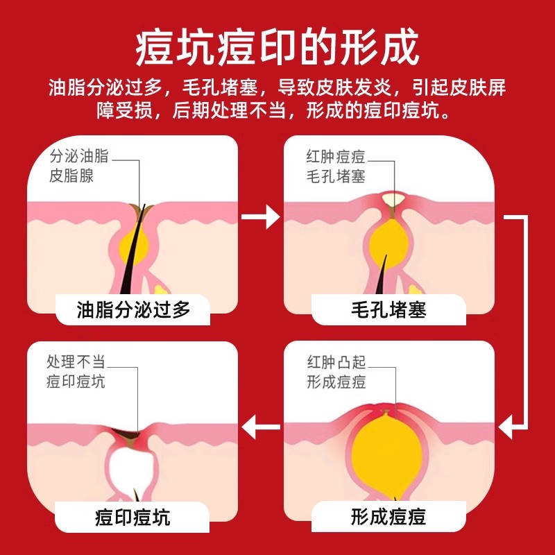 bargo医用祛痘印修复淡化皮肤黑色素沉淀痘坑痘疤修复膏精华凝胶