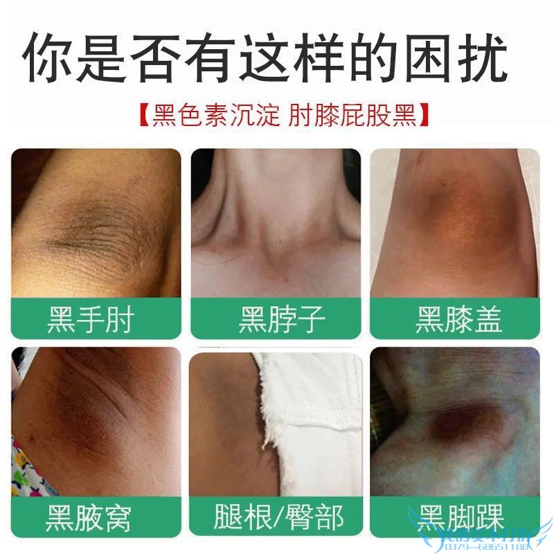 屁股去黑痘印坐印疤痕淡化黑色素沉淀大腿根部腋窝黑印私处美白霜-图2