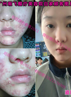 3号中草本去印醋疗暗疮面膜粉