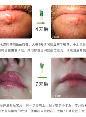 德国ilon唇部护理膏 10ML唇周唇 干燥起皮小泡 嘴角上火 泡