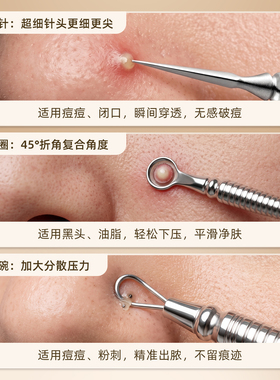 张小泉粉刺针去黑头工具挤压器痘痘美容院专用闭口暗疮脂肪粒