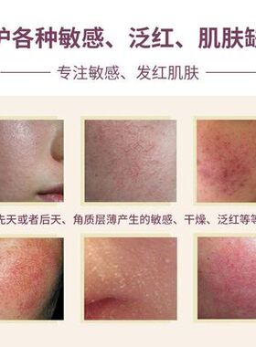 洋甘菊护肤品套装去红血丝五件套