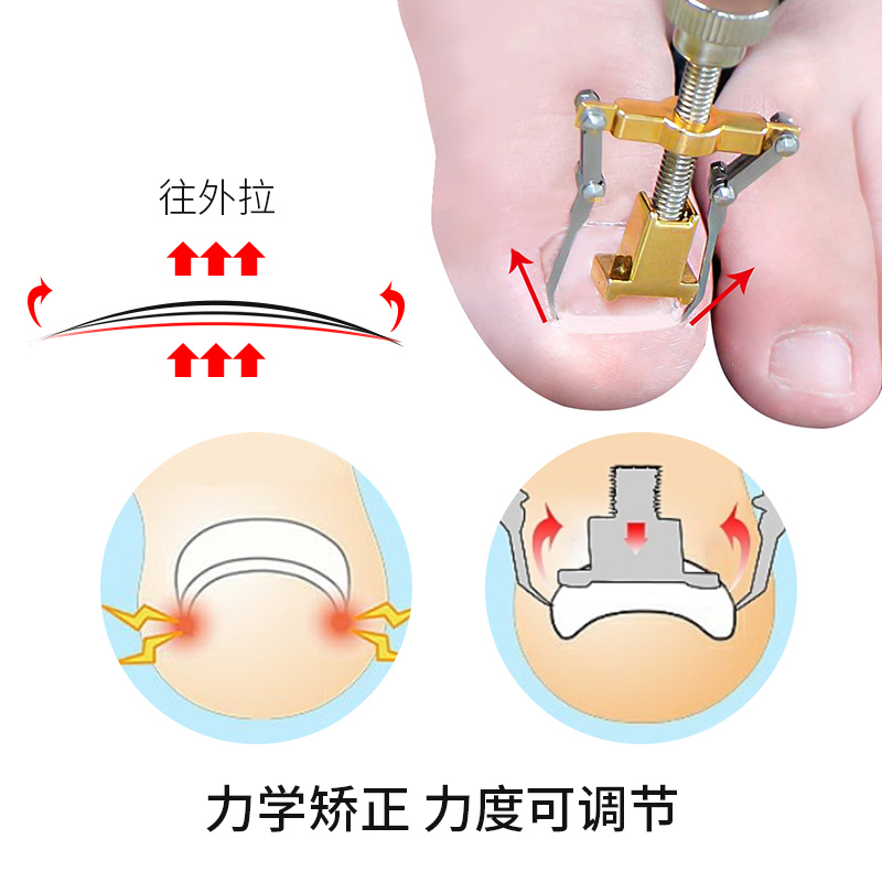 炎甲沟矫正器嵌甲修正趾甲长肉里拉贴拉正脚指甲修脚套装家用工具 - 图1