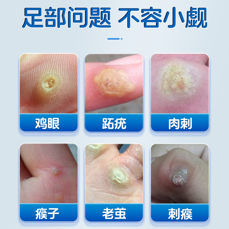 鸡眼贴膏去鸡贴眼非去除扁平疣跖疣瘊子疣老茧足部脚底药膏神器