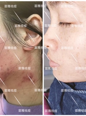 苗雅草本祛痘膏中药去痘红肿痘印闭口粉刺痤疮除螨青春痘男女学生