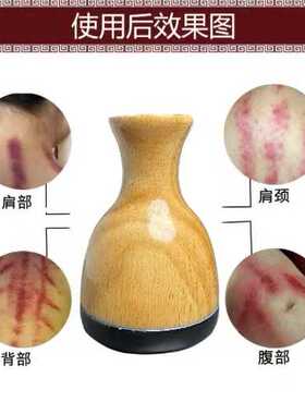 玄黄砭石热敷理疗无烟聚阳艾炙盒