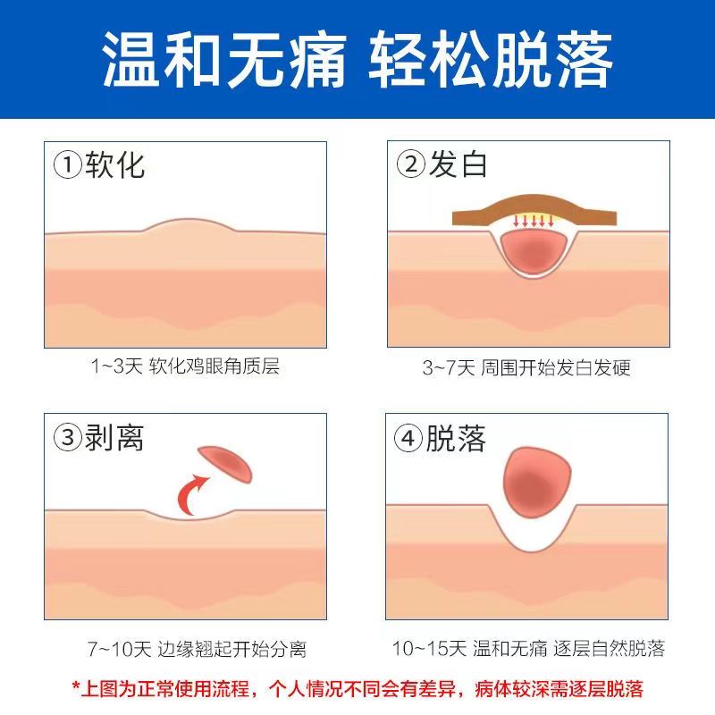 德国鸡眼贴洁沃鸡眼膏去鸡眼脚趾长厚茧硬茧脚底老茧贴无痛掉药用 - 图2