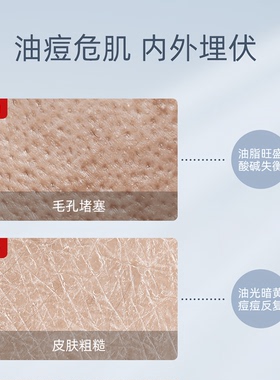 军献精华袪痘膏袪痘印红肿痘青春学生控油温和抗痘精华草本无激素