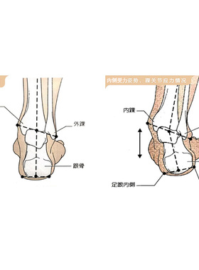 o型腿走路姿势纠正足内翻矫正器