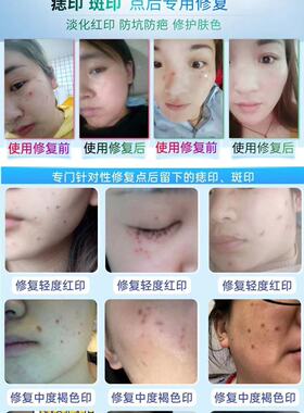 点斑点黑痣退红素修复液去痘印淡化红血丝止痒去红印修复液