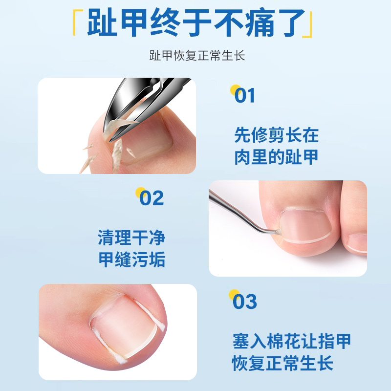 甲沟塞棉花专用矫正器脚趾甲嵌甲卷甲纠正工具填充隔离垫片神器炎 - 图1