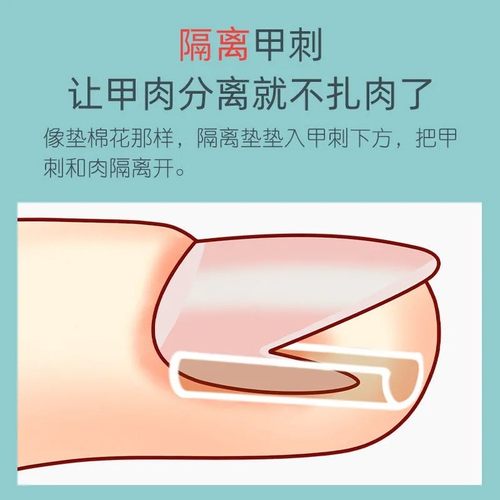 甲沟炎神器指甲矫正器嵌甲专用隔离填充垫片脚趾甲往肉里长纠正甲 - 图1