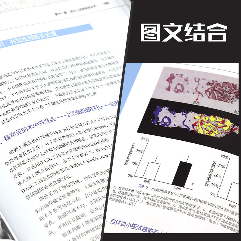 正版 上颌窦植骨与种植书 林野 主编 口腔种植学书籍和牙手术学图解美学区域的修复精准植入技巧数字化实用技术精要现代牙科牙体