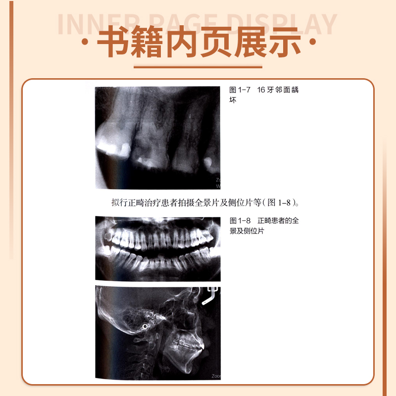 食物嵌塞的修复治疗 图解口腔美学种植修复临床规范丛书 于海洋 可搭配赝复体治疗修复预告技术规范牙科比色操作手册 - 图2