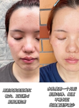 无语茶里茶气控油爽肤水油皮闭口痘痘去角质补水乳夜 精华