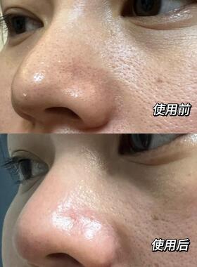 ilso黑头导出液去黑头溶解皮脂闭口粉刺黑头水深层毛孔清洁鼻贴