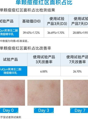 S/养护痘肌！芙清20%壬二酸清痘精华乳祛痘舒缓肌肤控油舒缓痘痘