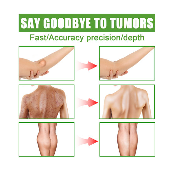 Fatty Lumps Cream Unclogging Body Multiple Fatty Lumps Tumou