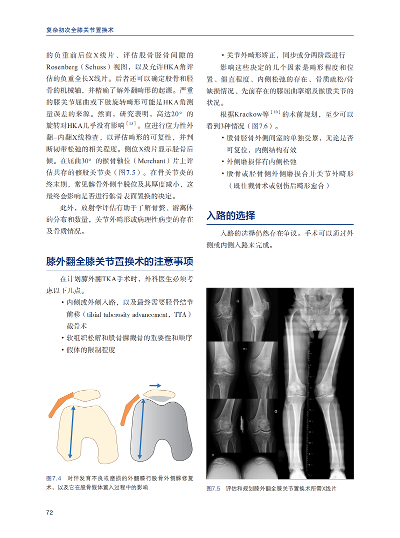 复杂初次全膝关节置换术 S. K.S.Marya主编 山东科学技术出版社 适合外科医生及医学生阅读 膝关节畸形的复杂性外翻内翻固定屈曲 - 图1