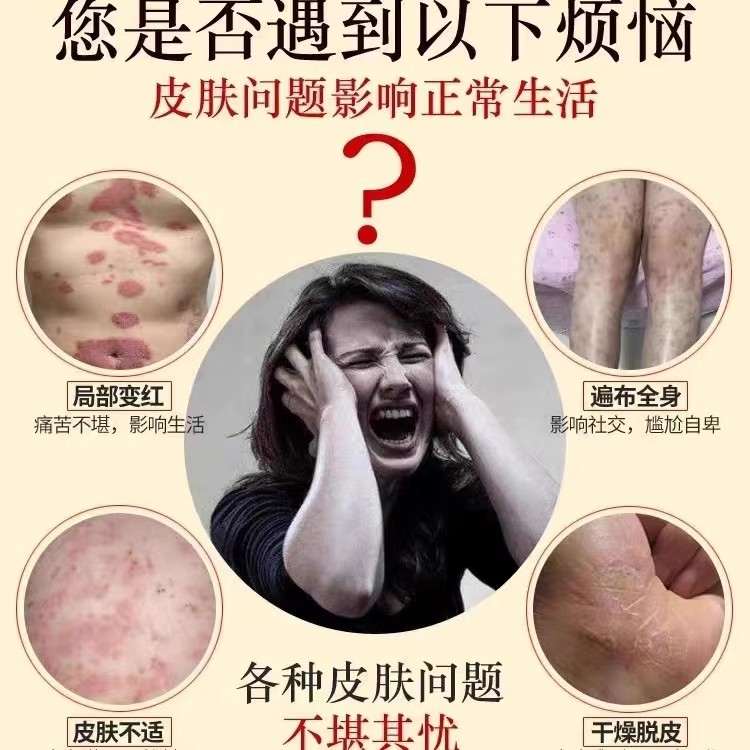 湿疹止痒外用去顽固皮炎根皮肤瘙痒玫瑰糠疹专用德国药特效抑菌膏 - 图0