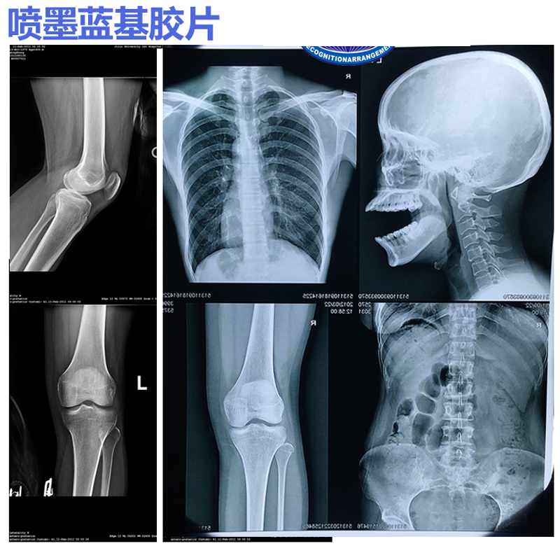 医用蓝片CT DR X光MR磁共振胶片高清放射干式蓝基蓝色喷墨片100张 - 图2