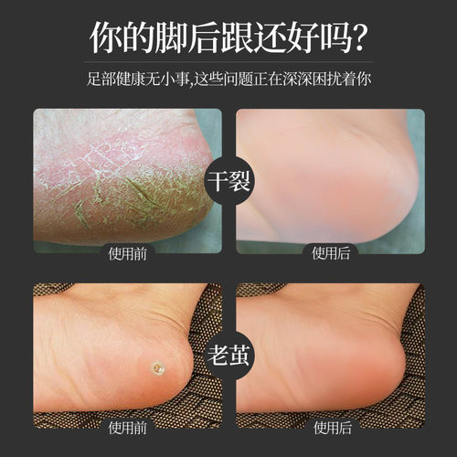 脚后跟保护套男女干裂开裂足护脚套防脚裂足跟硅胶套保湿防裂袜子 - 图2