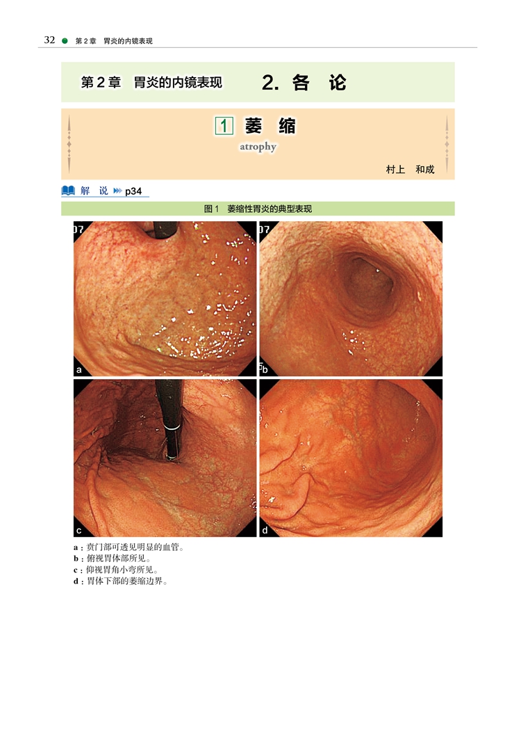 京都胃炎分类慢性胃炎胃癌风险内镜诊断与分类表现胃炎分类辅助诊断治疗胃炎临床治疗胃炎内镜诊断治疗技术胃镜内镜医师用书-图1