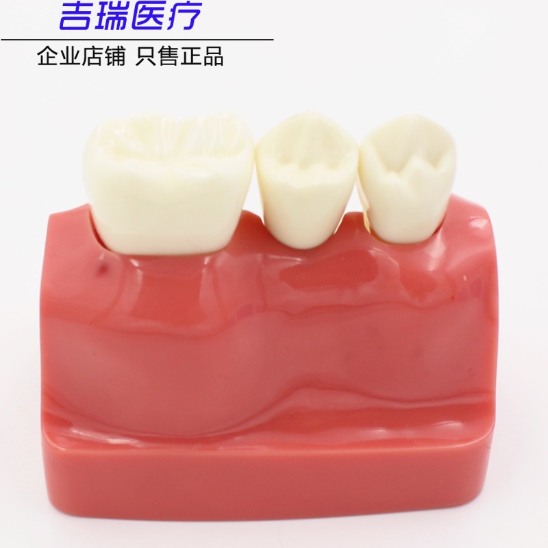 牙科 4倍种植解模型 义齿修复种植牙解说 可拆卸 连桥牙冠 种植模 - 图2