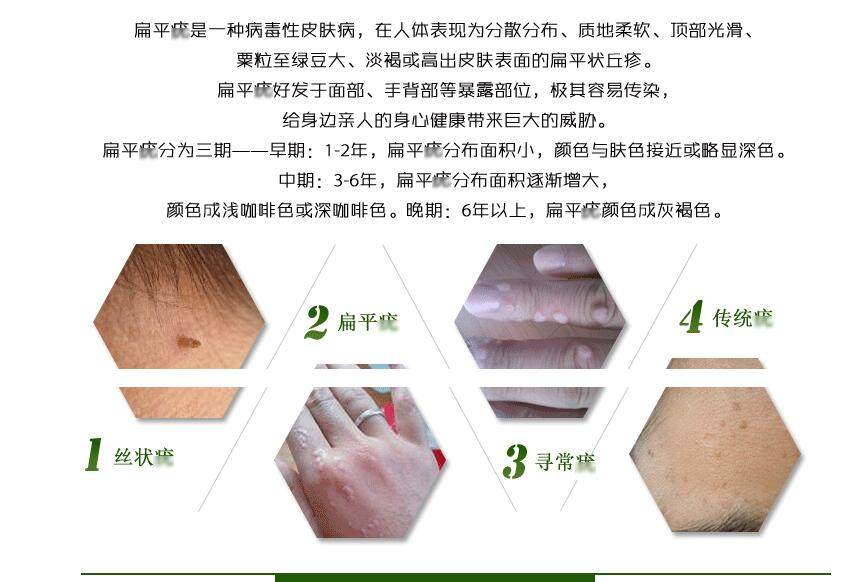 平疣图片,平疣的症状图片_大山谷图库