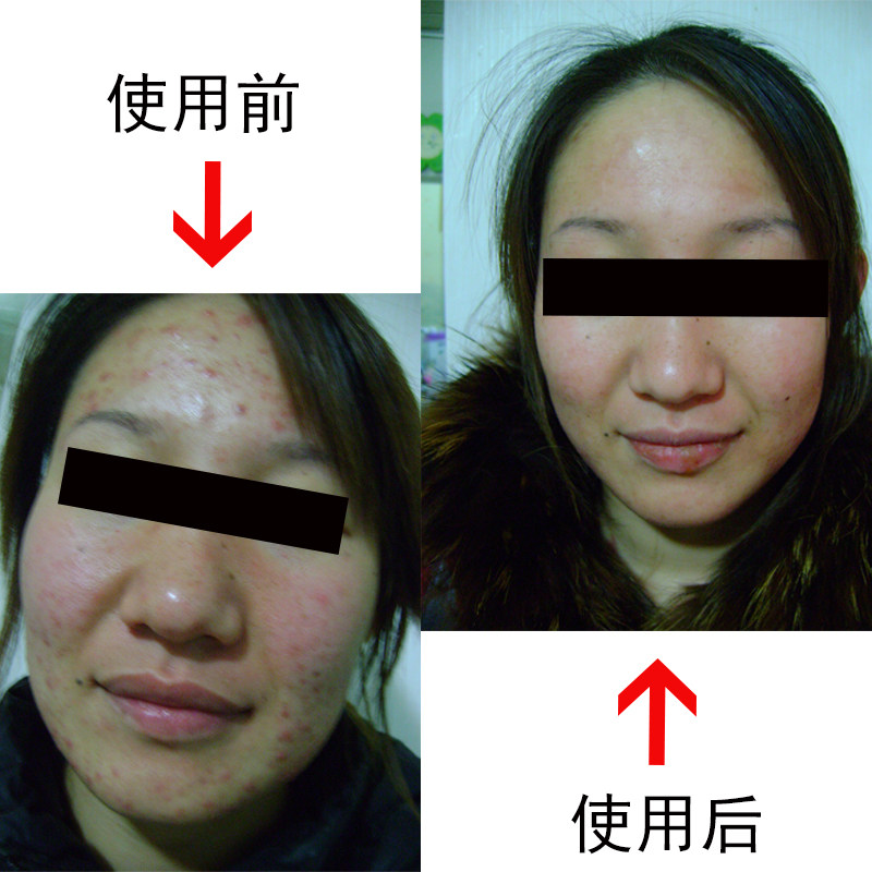 蓝金组合祛痘正品旗舰店10件套疙瘩洁面痤疮口服外用控油粉刺洗面