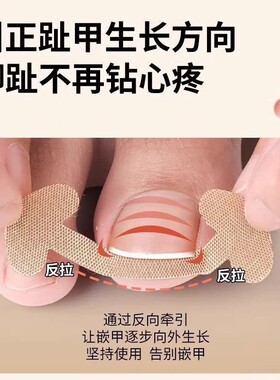 甲沟矫正器嵌甲贴片炎防脚指甲往肉里长专用工具隔离填充垫片神器