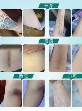 纹身贴遮盖疤痕隐形神器肉色伤疤增生凸凹陷胎记痘印皮肤持久防水