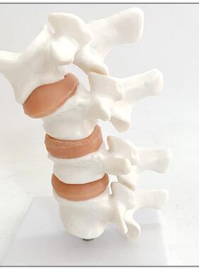 人体脊椎变模型 骨质疏松病变腰椎椎间盘 骨骼模型 脊椎模型