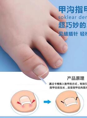 矫正器指甲专用趾甲纠正美甲工具