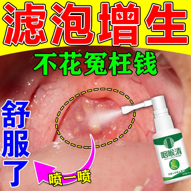 极速咽喉后壁淋巴滤泡增生除慢性咽炎根舌根扁桃体发炎药咽喉肿痛-图0