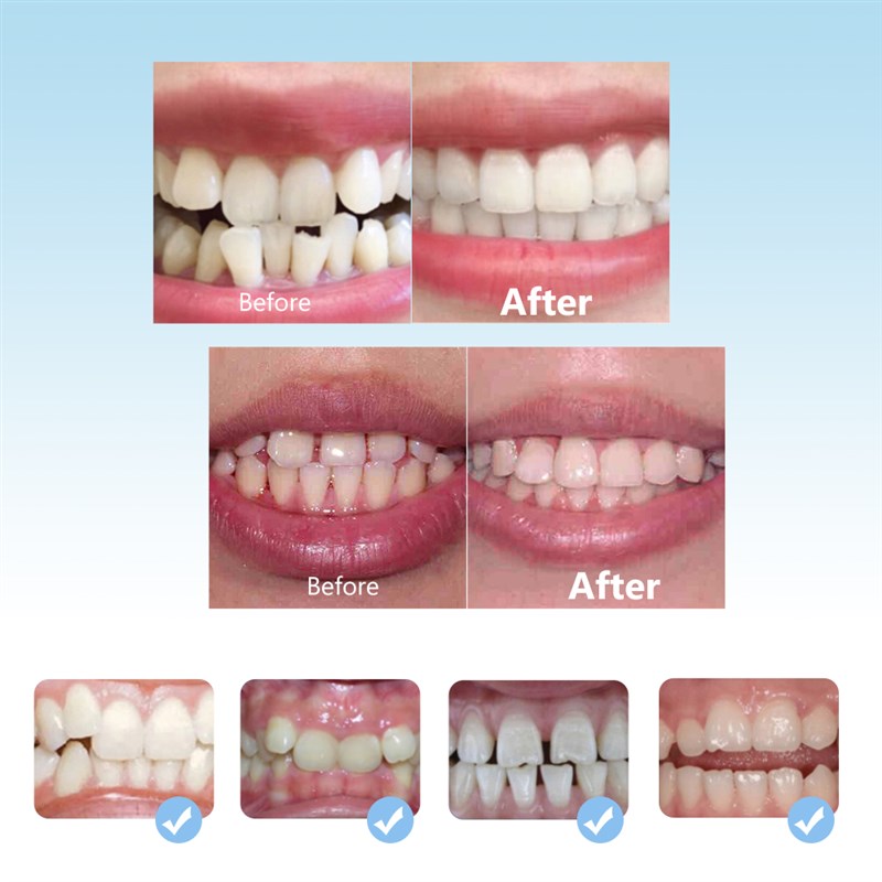 速发3pcs/set Dental Braces for Teeth Straightener Orthodonti - 图0