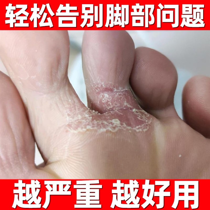 推荐手足藓去痒湿疹腿部一抹灵药膏脚廯中医除臭皮肤病乾燥水泡宝 - 图0