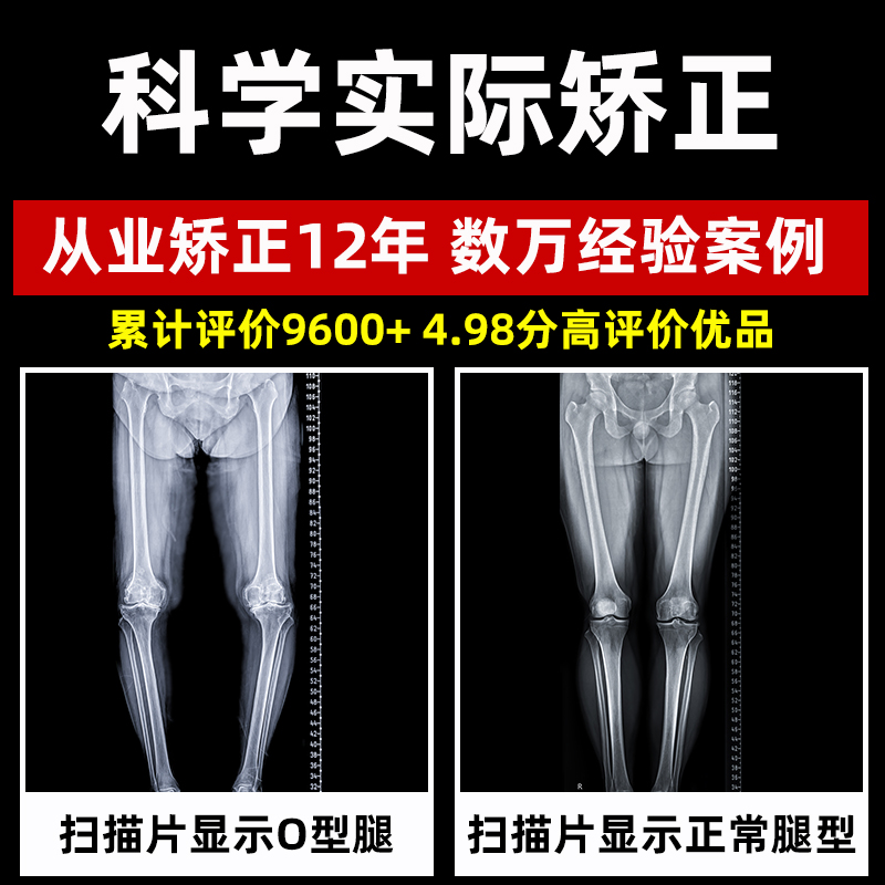 儿童O型腿矫正器绑腿带直腿神器矫正带小腿外翻XO型腿宝宝纠正带 - 图2