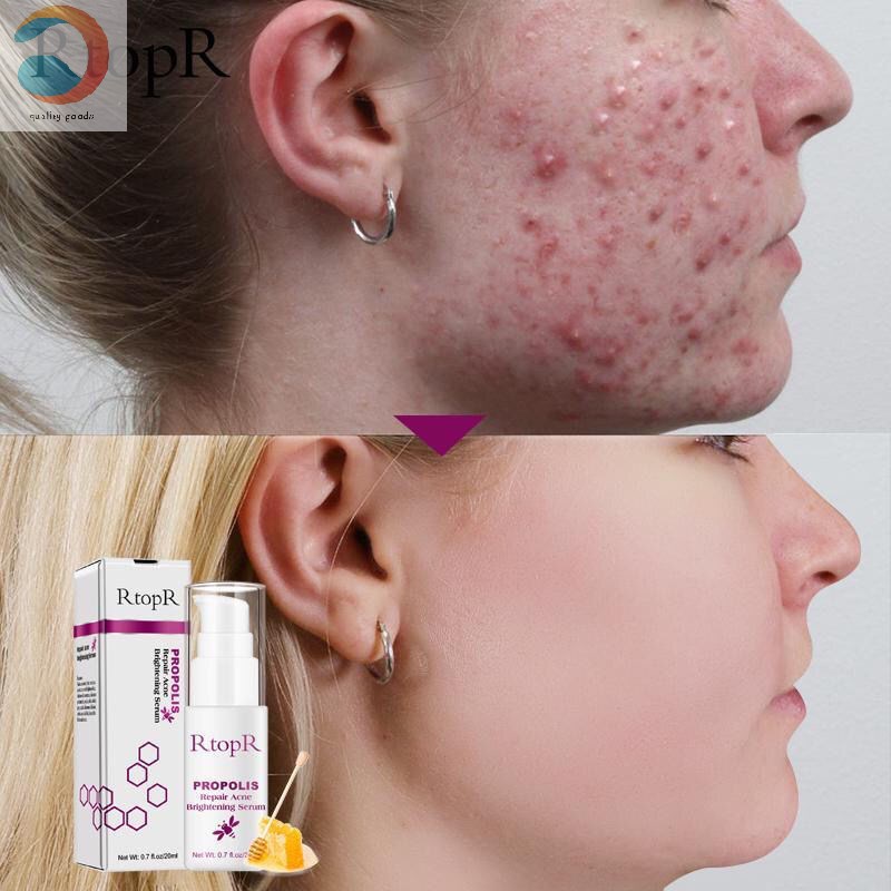 推荐Propolis Repair Acne Brightening Serum Scar Spots Cleani - 图1