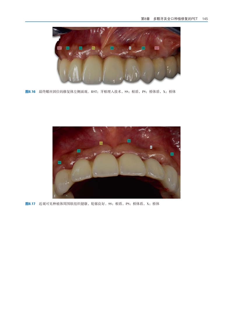 正版现货口腔种植部分拔牙治疗技术王佐林范震胥春辽宁科学技术出版社9787559132697-图2