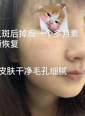 点斑水无痕正品古方金水脸部植物