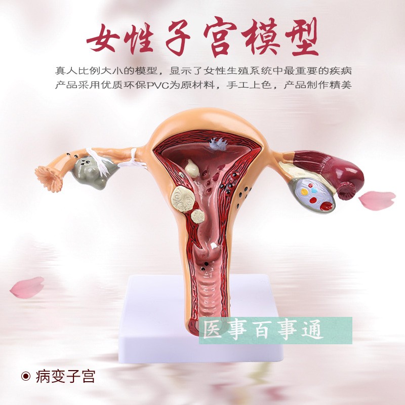 子宫、卵巢病理病变模型 生殖科 医药礼品模型 女性子宫阴道模型 - 图0