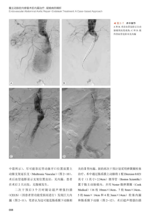 全2册 腹主动脉腔内修复术后内漏治疗疑难病例精析+挑战性动脉重建100例 应用外科技术进行相关血管修复血管内漏动脉瘤腔内修复术 - 图3