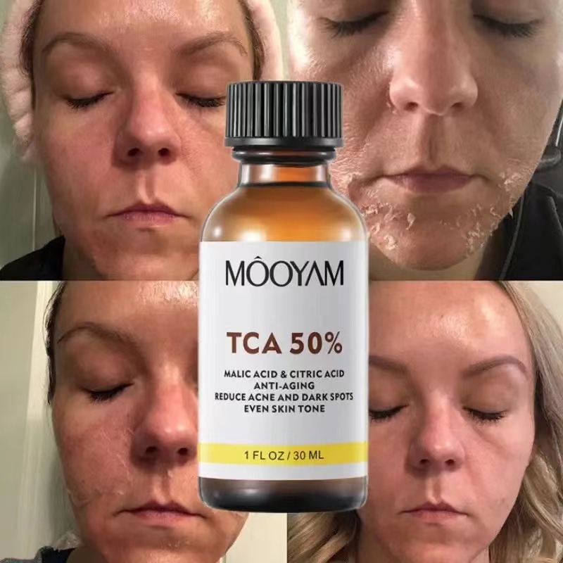 TCA 50% Chemical Peel Tca Peel Acid Skin Superforce Peel-图0