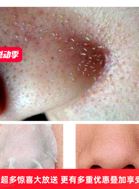 皙芙妮净透黑头导出液韩国小气泡