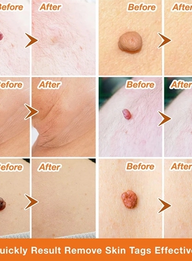 Skin Tag Remover Cream Painless Mole Skin Dark Spot Warts Re