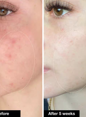 在途iNNBEAUTY PROJECT Acne Serum去豆精华30ml 水杨传明s烟酰a