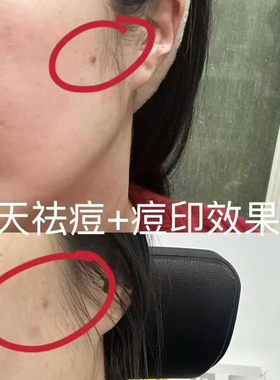 【24h祛痘】UniTouch优莉缇祛痘精华鼻贴鱼子面膜动能素抗皱精华