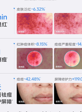 海龟爸爸青少年次抛祛痘精华液